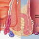 Illustration for article titled Ampuh 100% Cara Menyembuhkan Penyakit Ambeien Atau Wasir Secara Alamiem/em